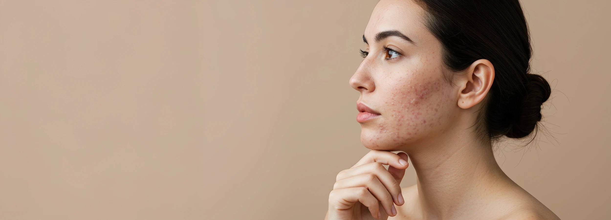 Премахване на белези от акне – ефективни решения и продукти